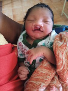 जब चिरायु टीम बनी एक परिवार की उम्मीद, जन्मजात विकृति से जूझ रहे बच्चे को मिला नया जीवन