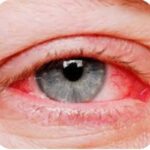 सारंगढ़-बिलाईगढ़ भीषण गर्मी में बढ़ रहा आंखों की बीमारियों का खतरा, स्वास्थ्य विभाग ने जारी की एडवायजरी